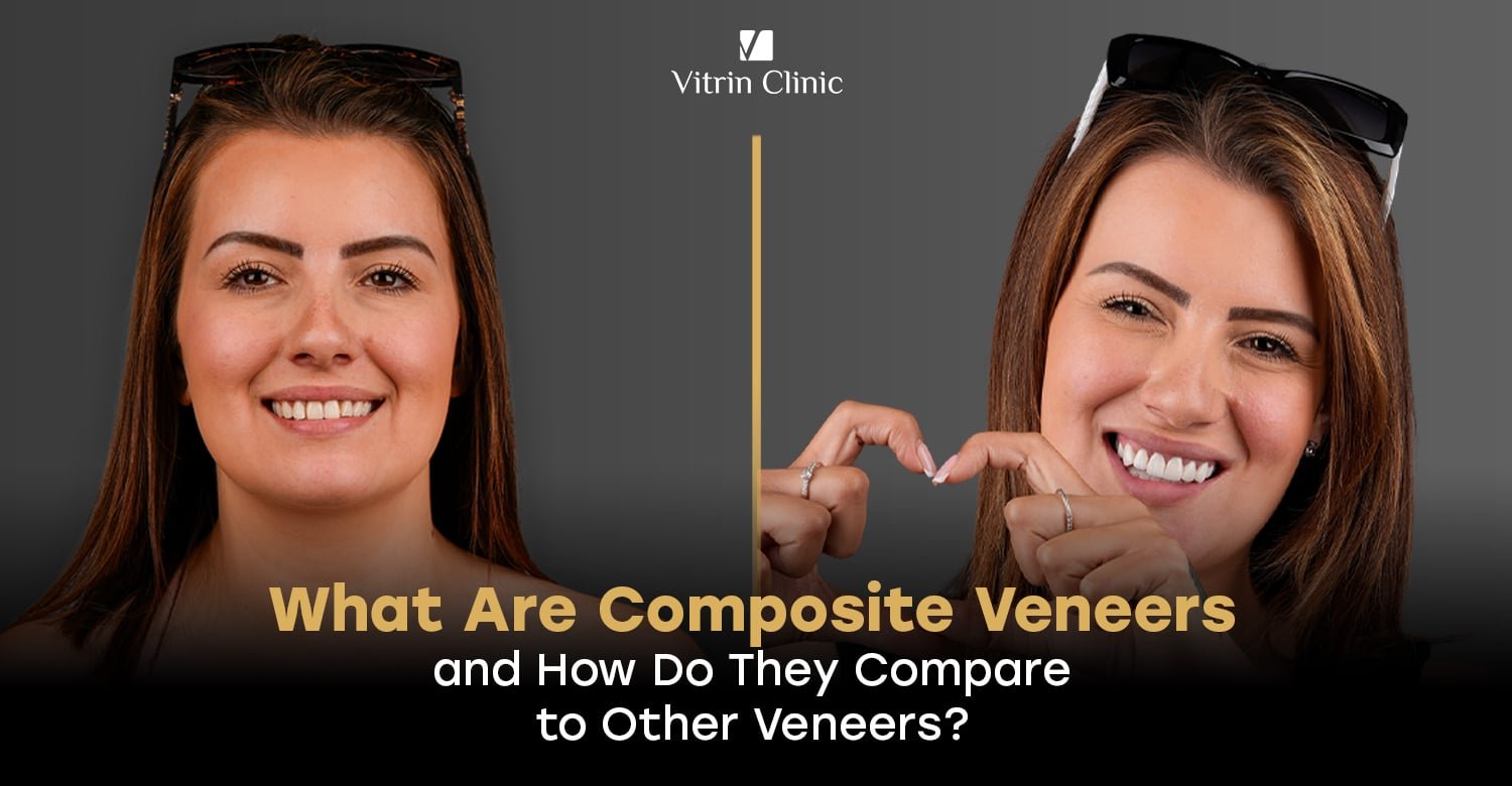 Composite veneers