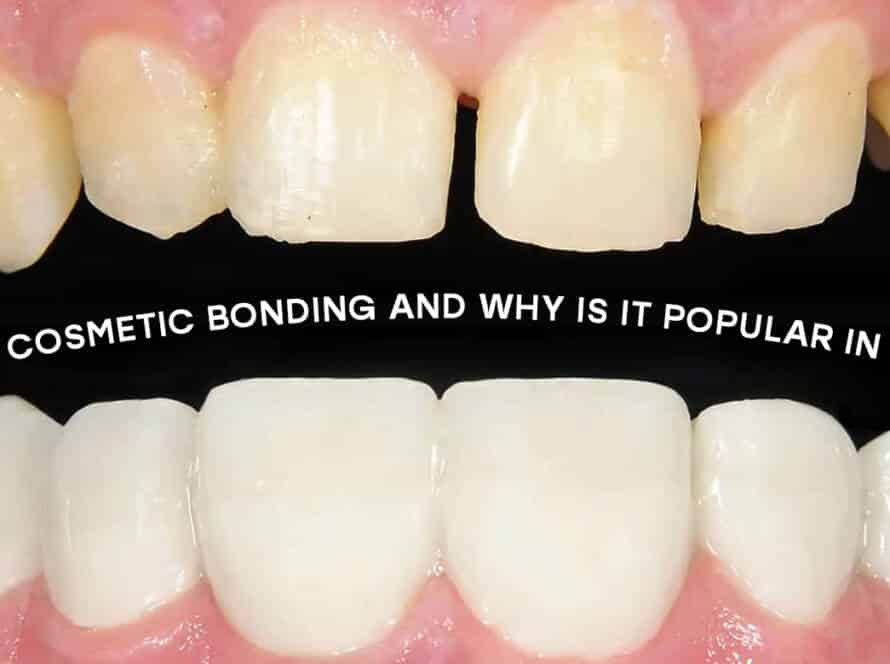 Cosmetic bonding