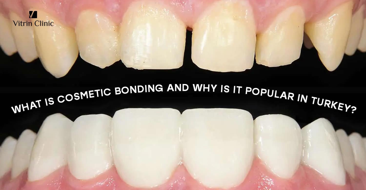 Cosmetic bonding