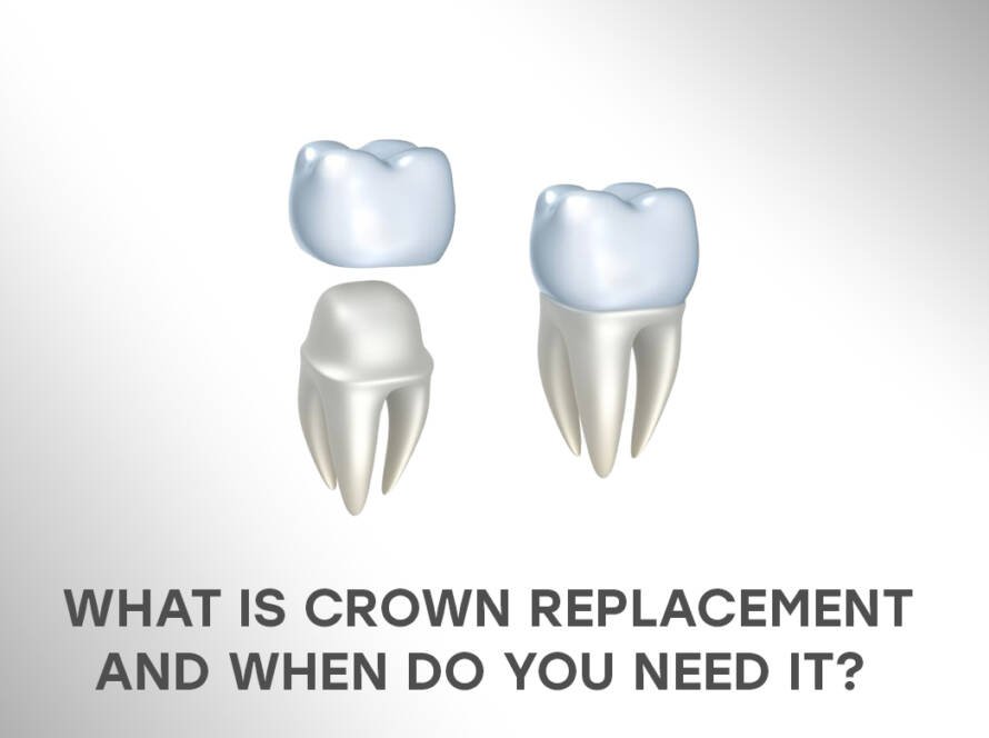 Crown replacement