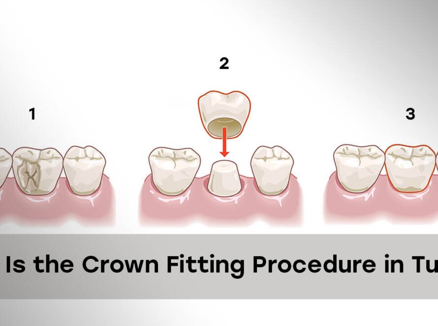 Crown fitting procedure