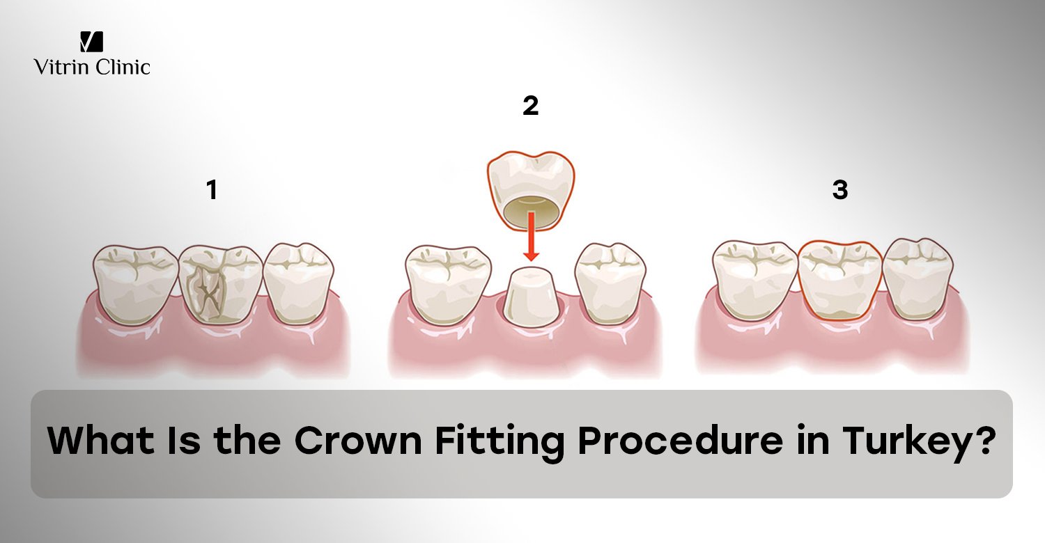 Crown fitting procedure