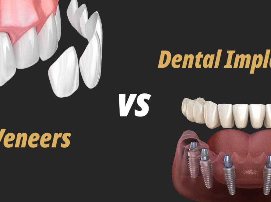 Dental Implants vs Veneers