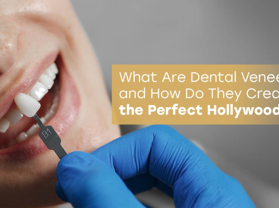 Dental Veneers