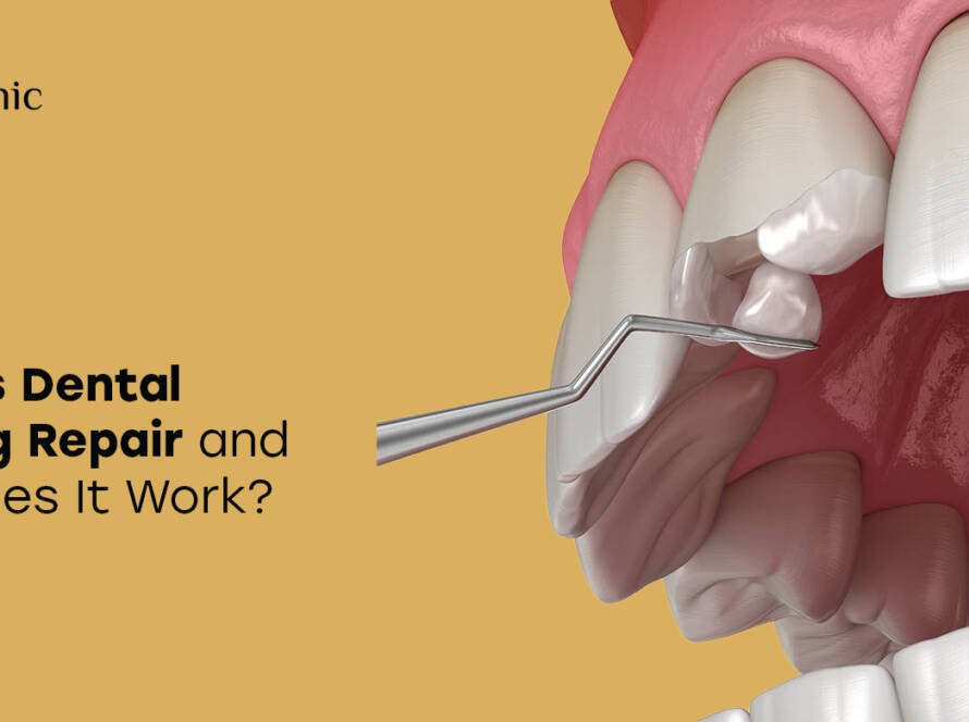 Dental bonding repair