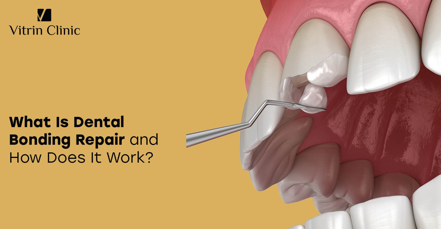 Dental bonding repair