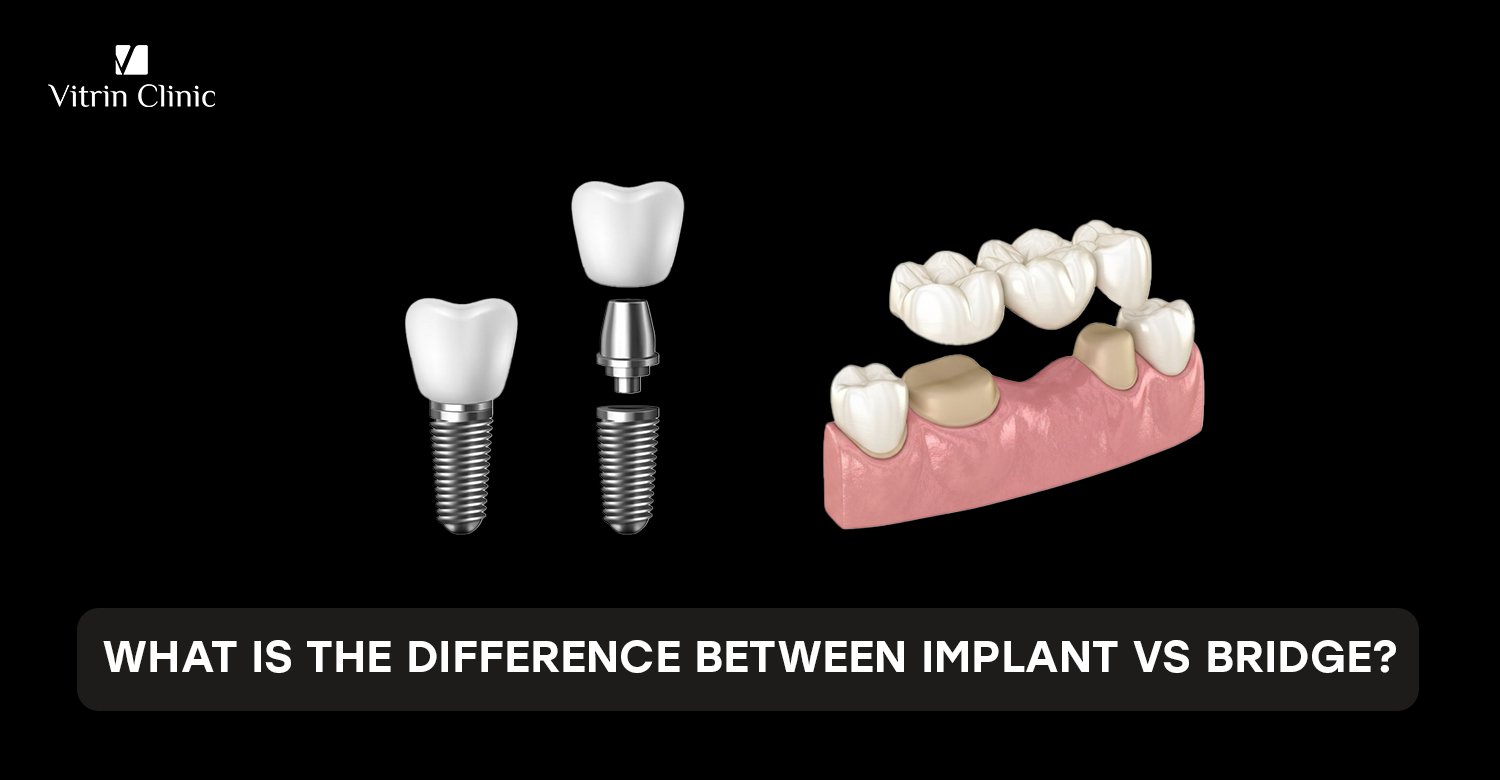 Implant vs bridge