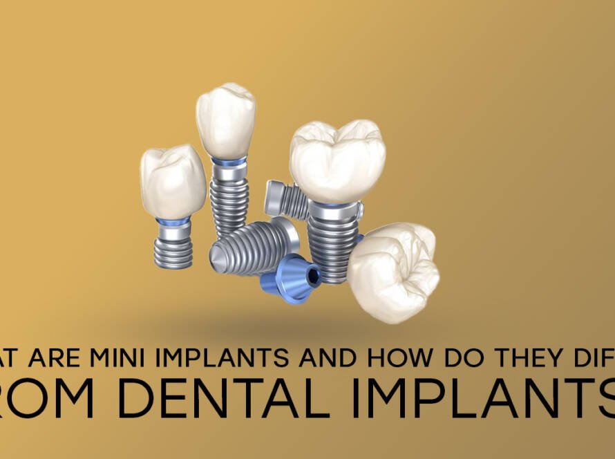 Mini implants