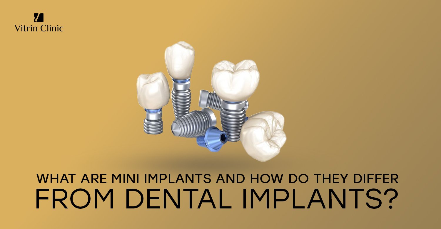 Mini implants