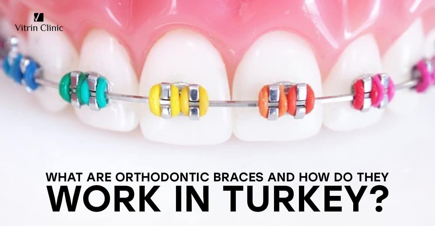 Orthodontic braces