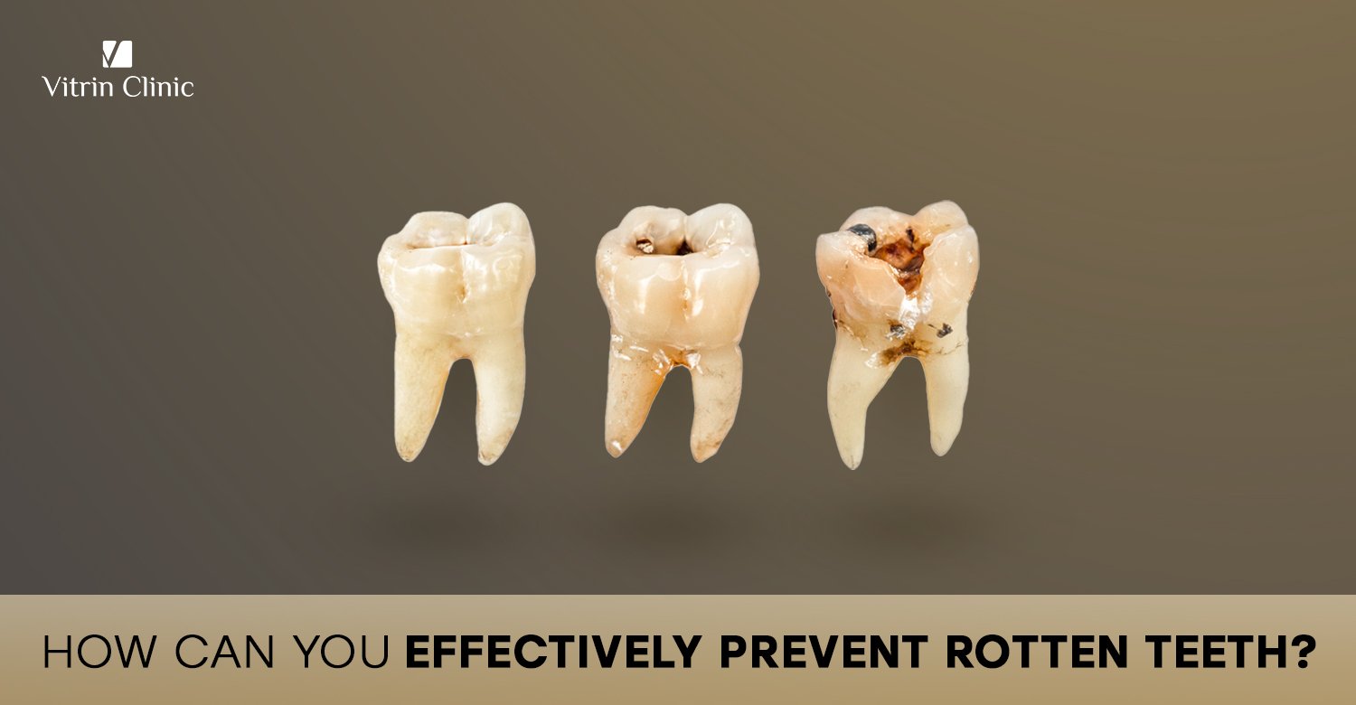 Preventing rotten teeth