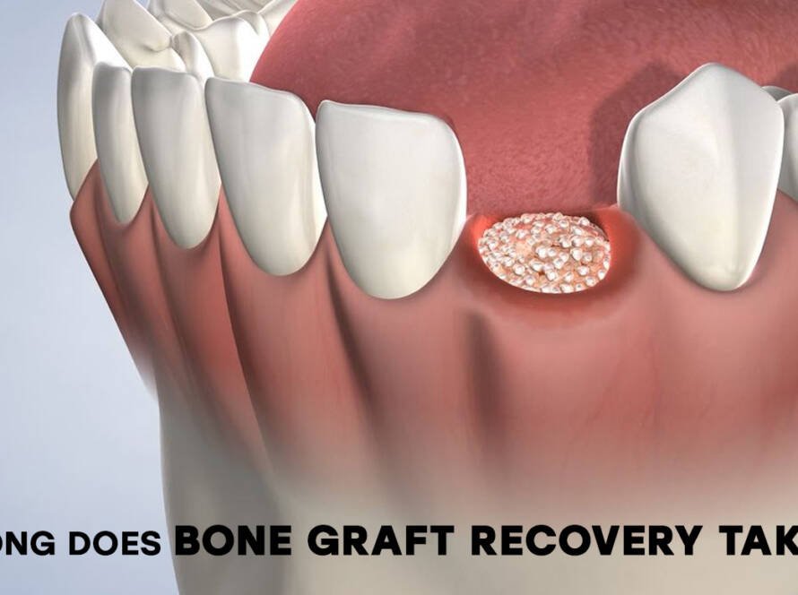 Recovery after bone graft