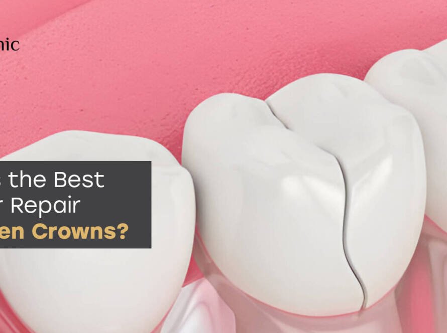 Repair of broken crowns