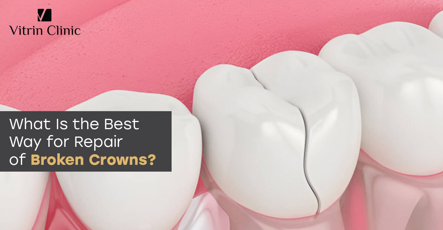 Repair of broken crowns