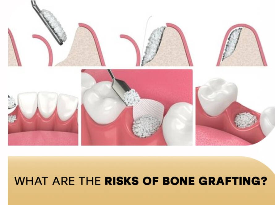 Risks of bone grafting