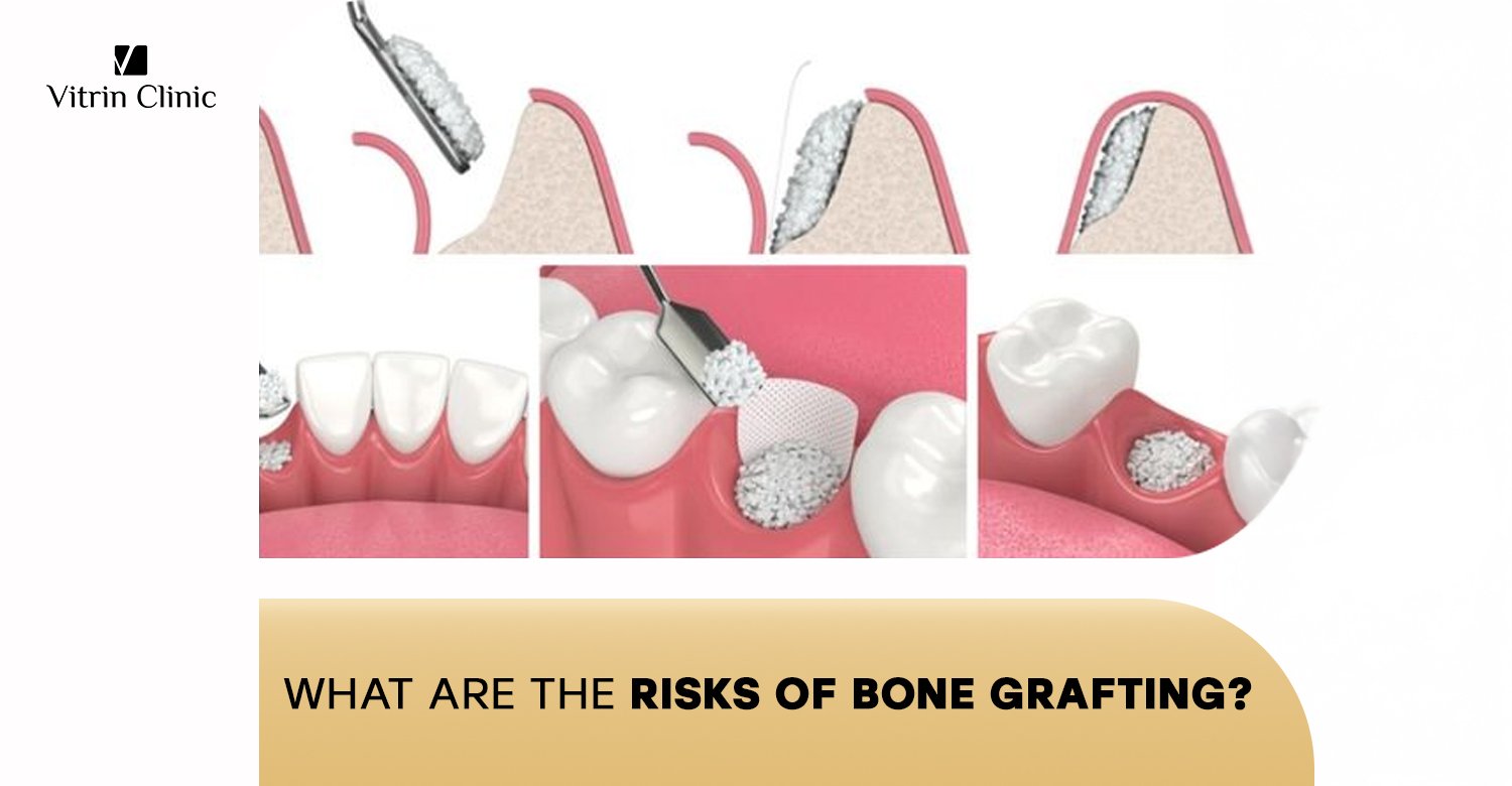 Risks of bone grafting