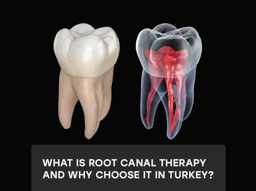 Root canal therapy