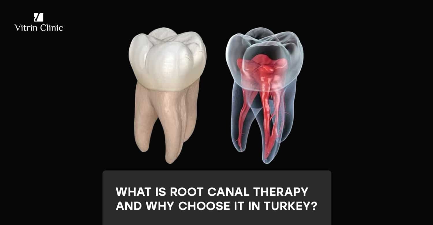 Root canal therapy