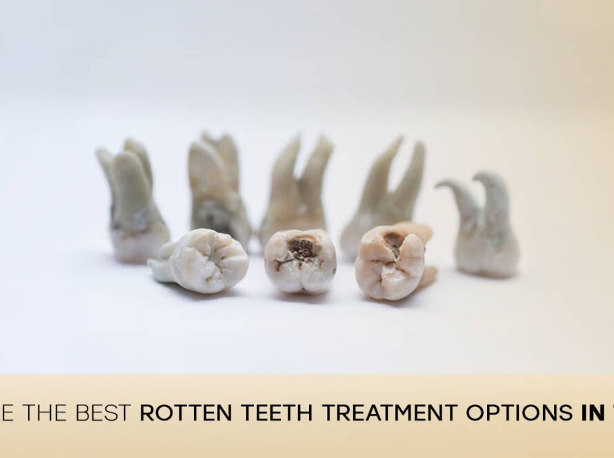 Rotten teeth treatment options