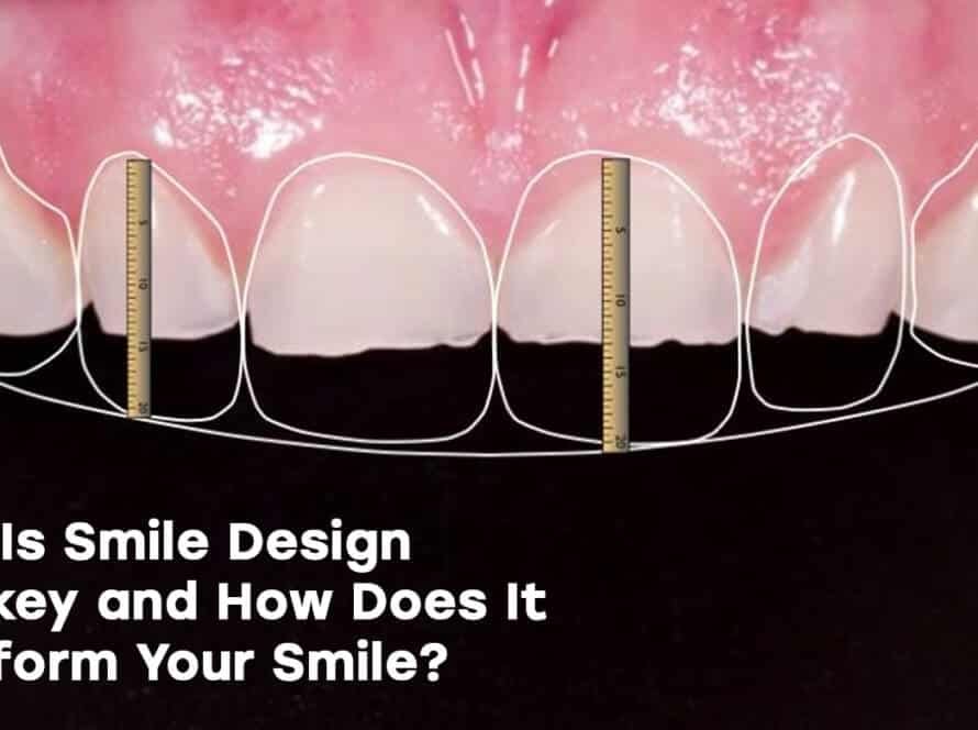 Smile design