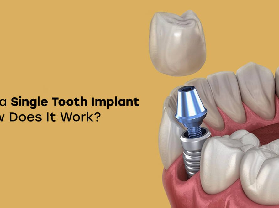 Single tooth implant