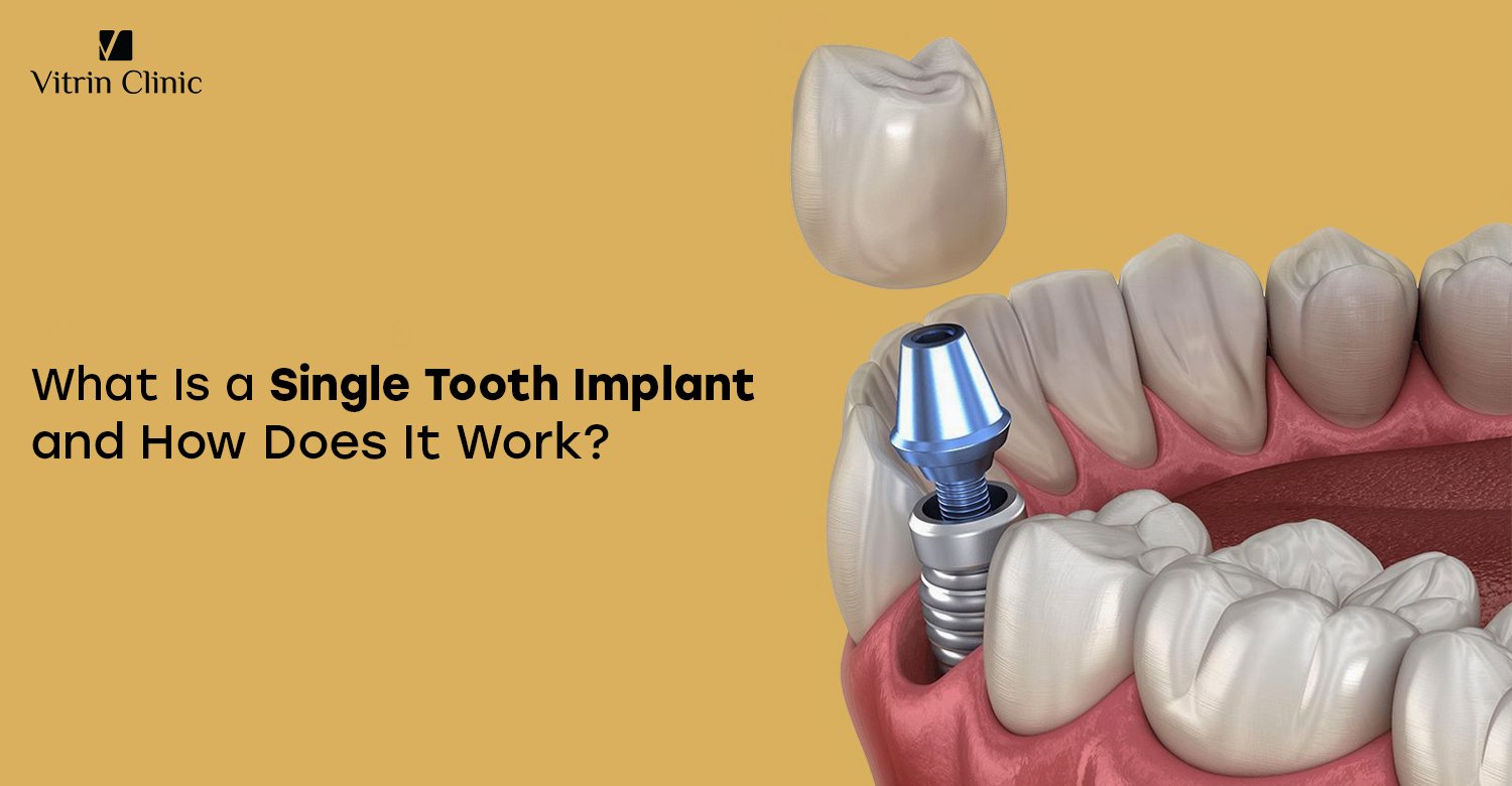 Single tooth implant