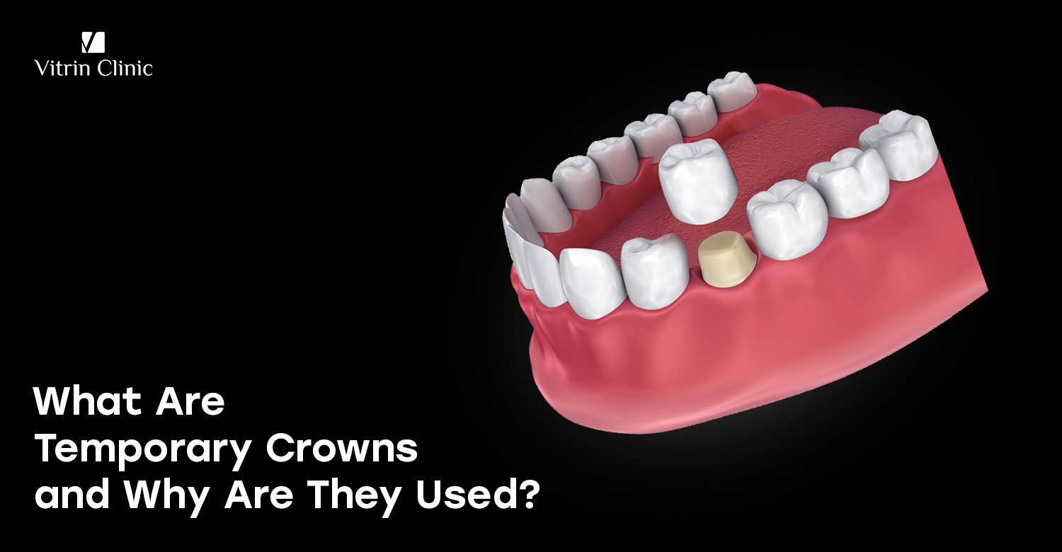 Temporary crowns