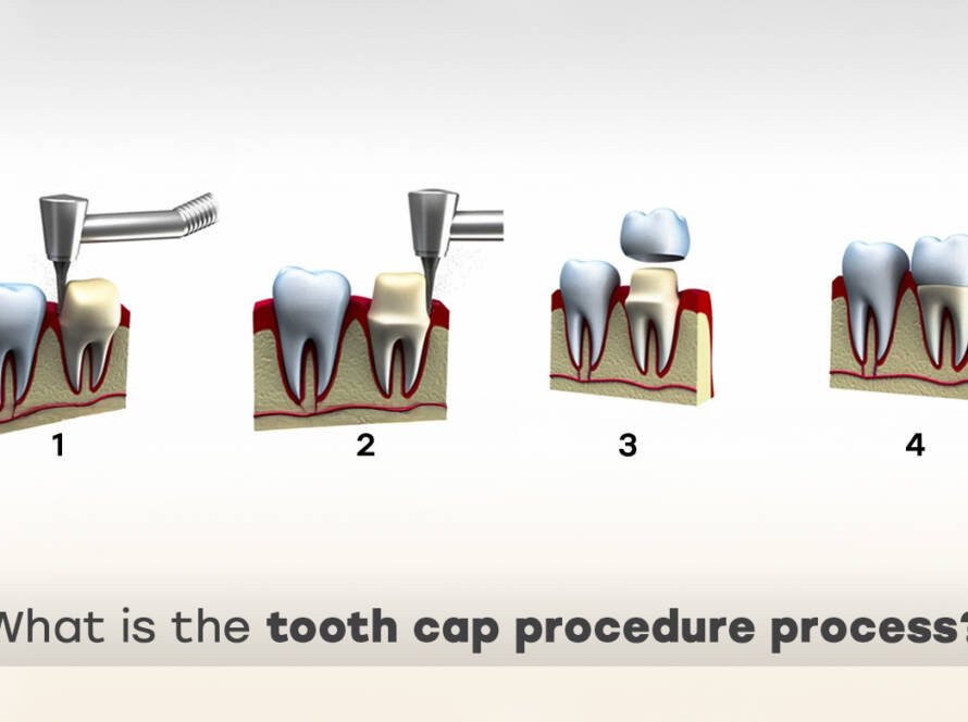 Tooth cap procedure