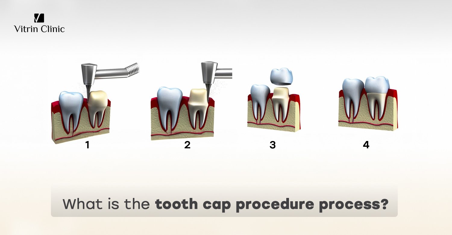 Tooth cap procedure