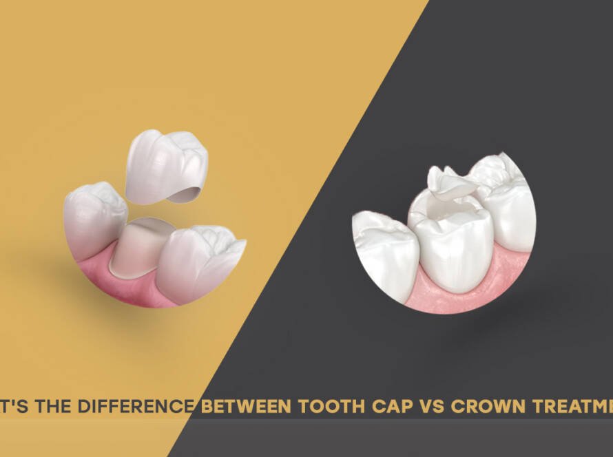 Tooth cap vs crown