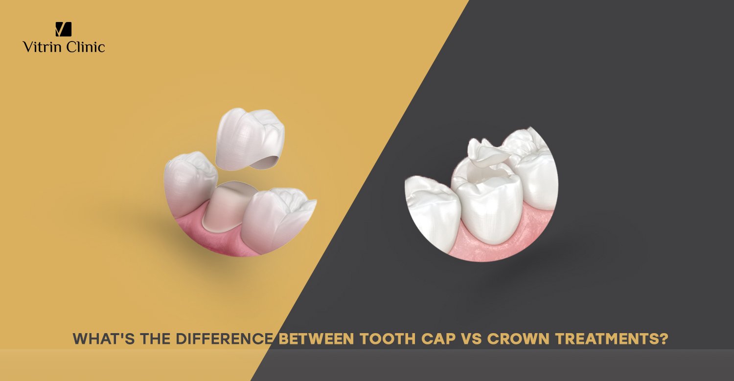 Tooth cap vs crown