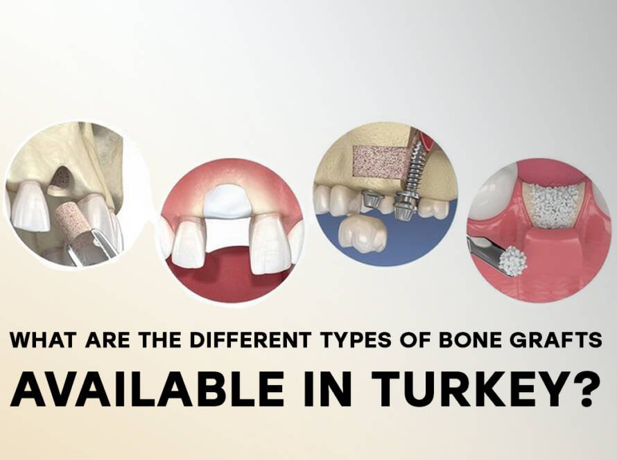 Types of bone grafts