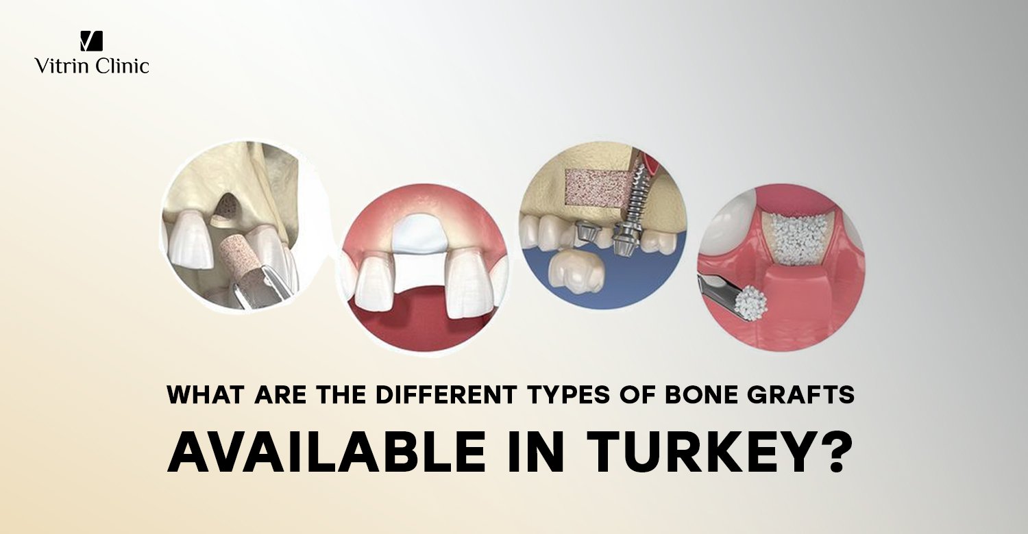 Types of bone grafts