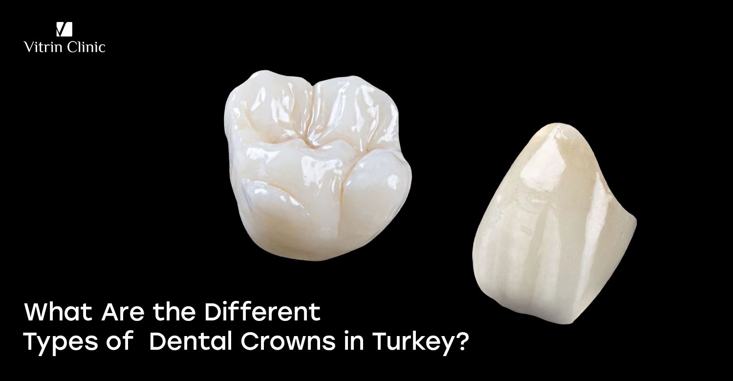 Types of dental crowns