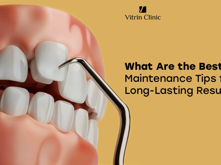 Veneer maintenance tips