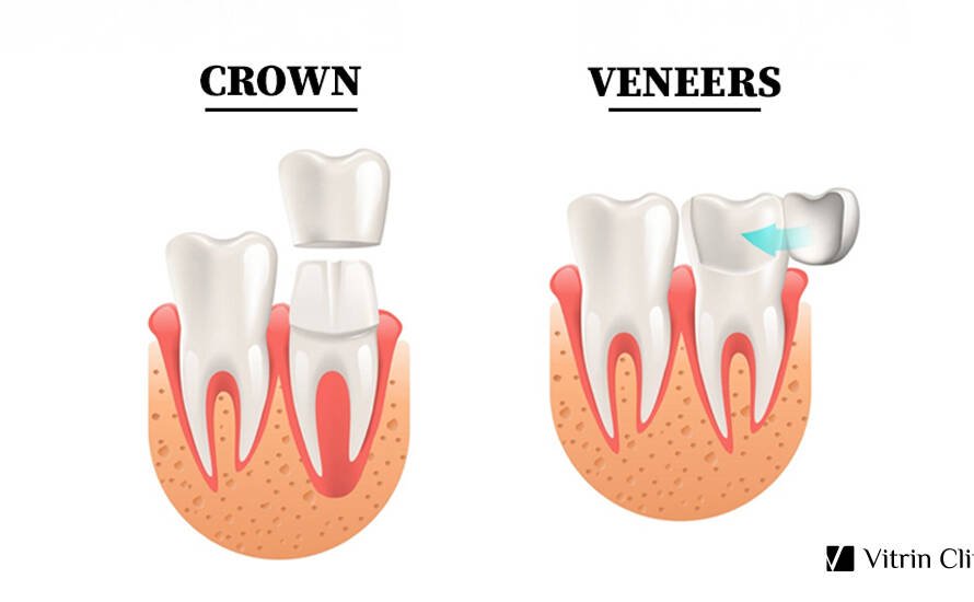 Veneers vs crowns