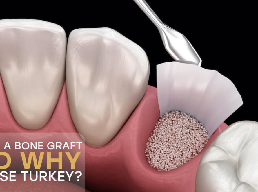 bone graft