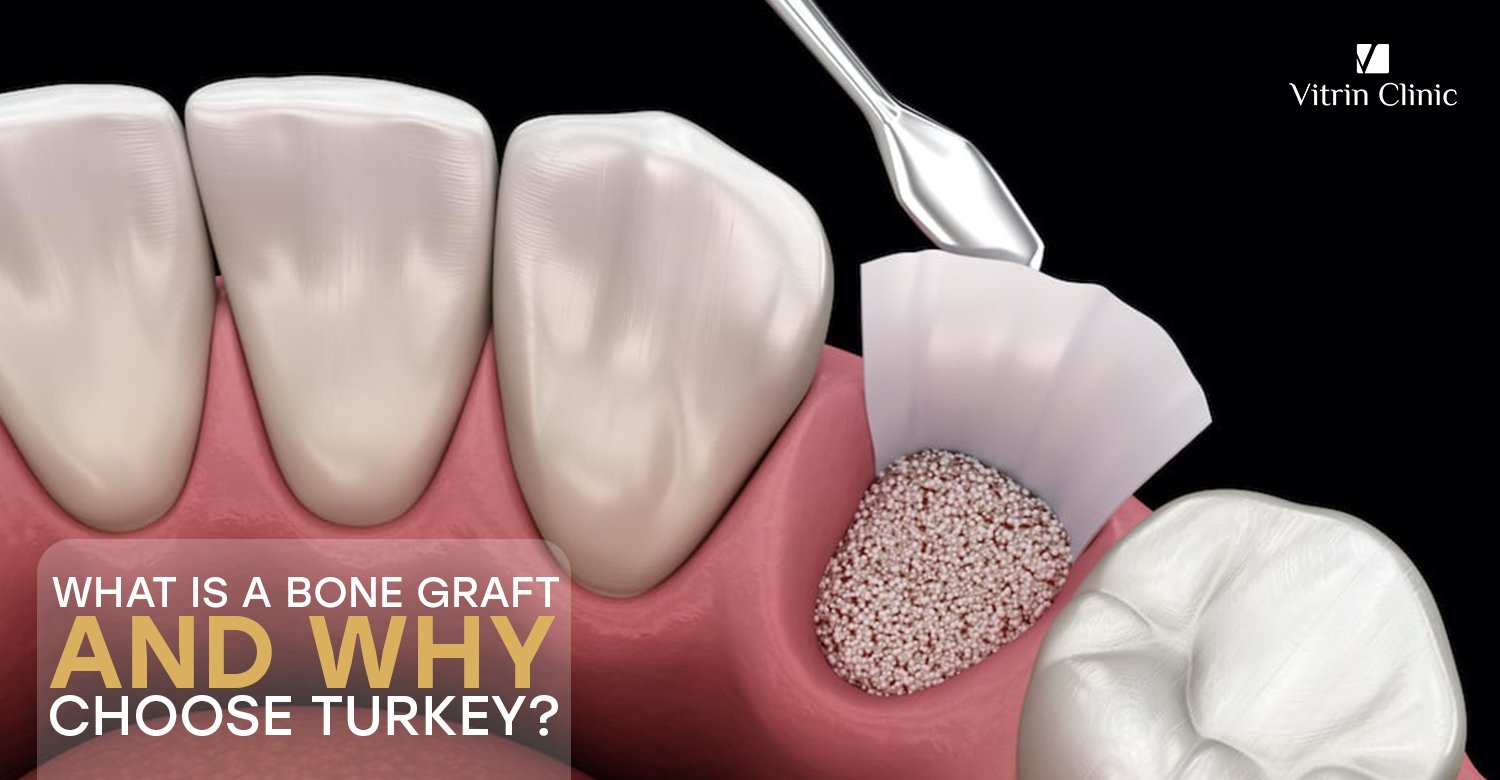 bone graft