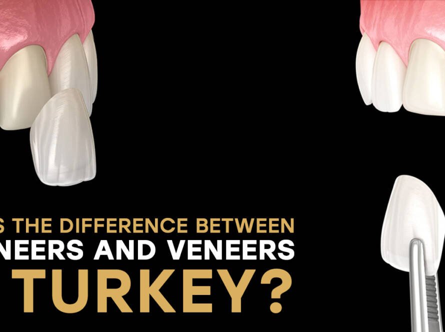 Lumineers vs veneers
