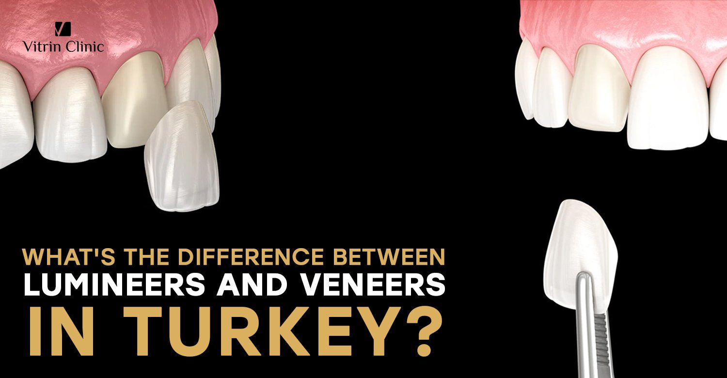 Lumineers vs veneers