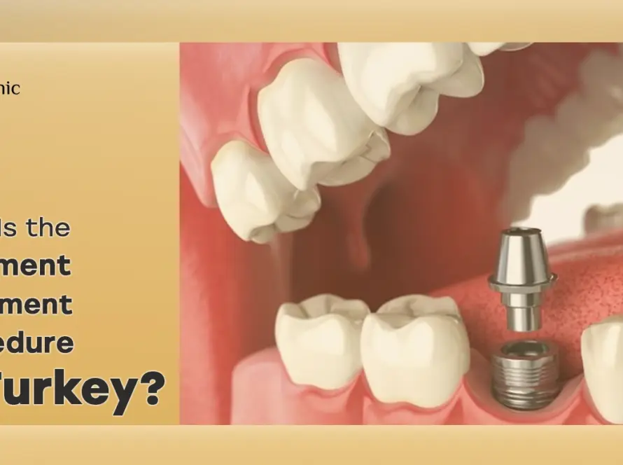 Abutment placement procedure
