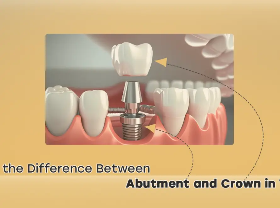 Abutment vs crown
