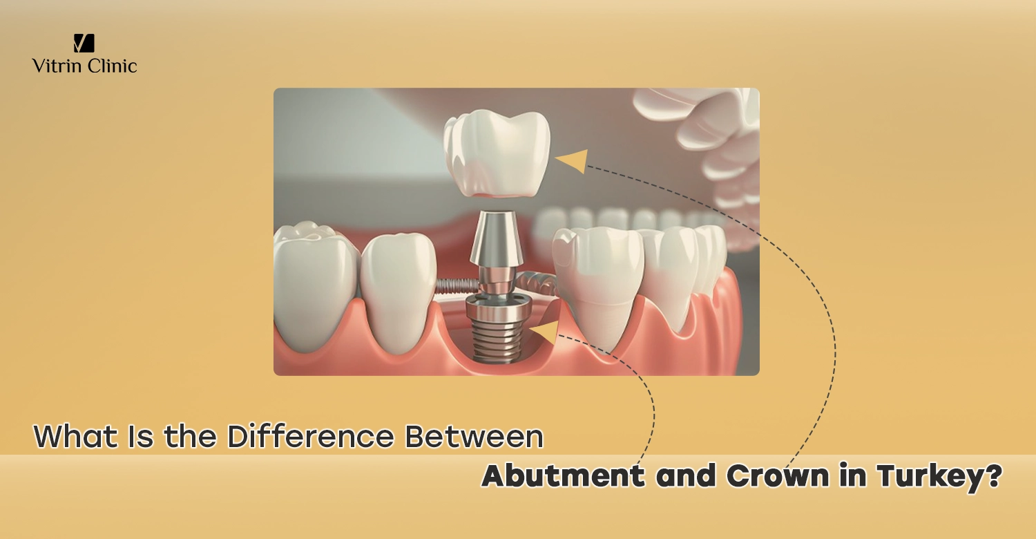 Abutment vs crown