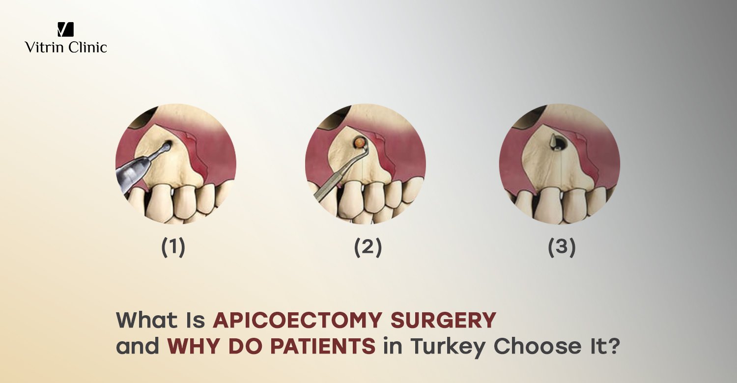 Apicoectomy surgery