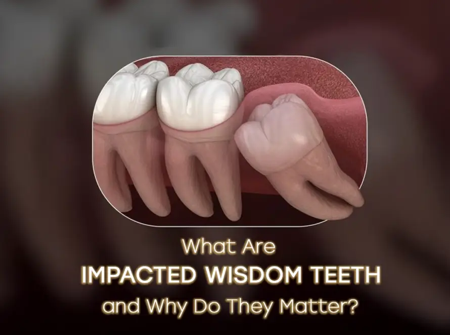 Impacted wisdom teeth