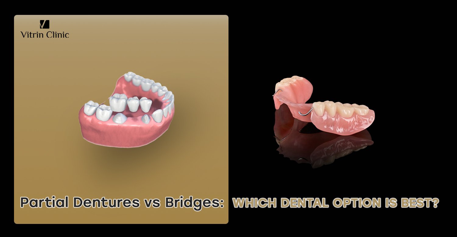 Partial dentures vs bridges