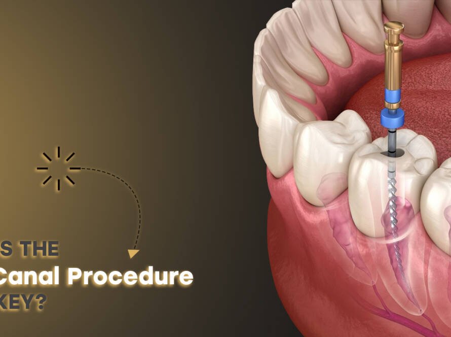 Root canal procedure
