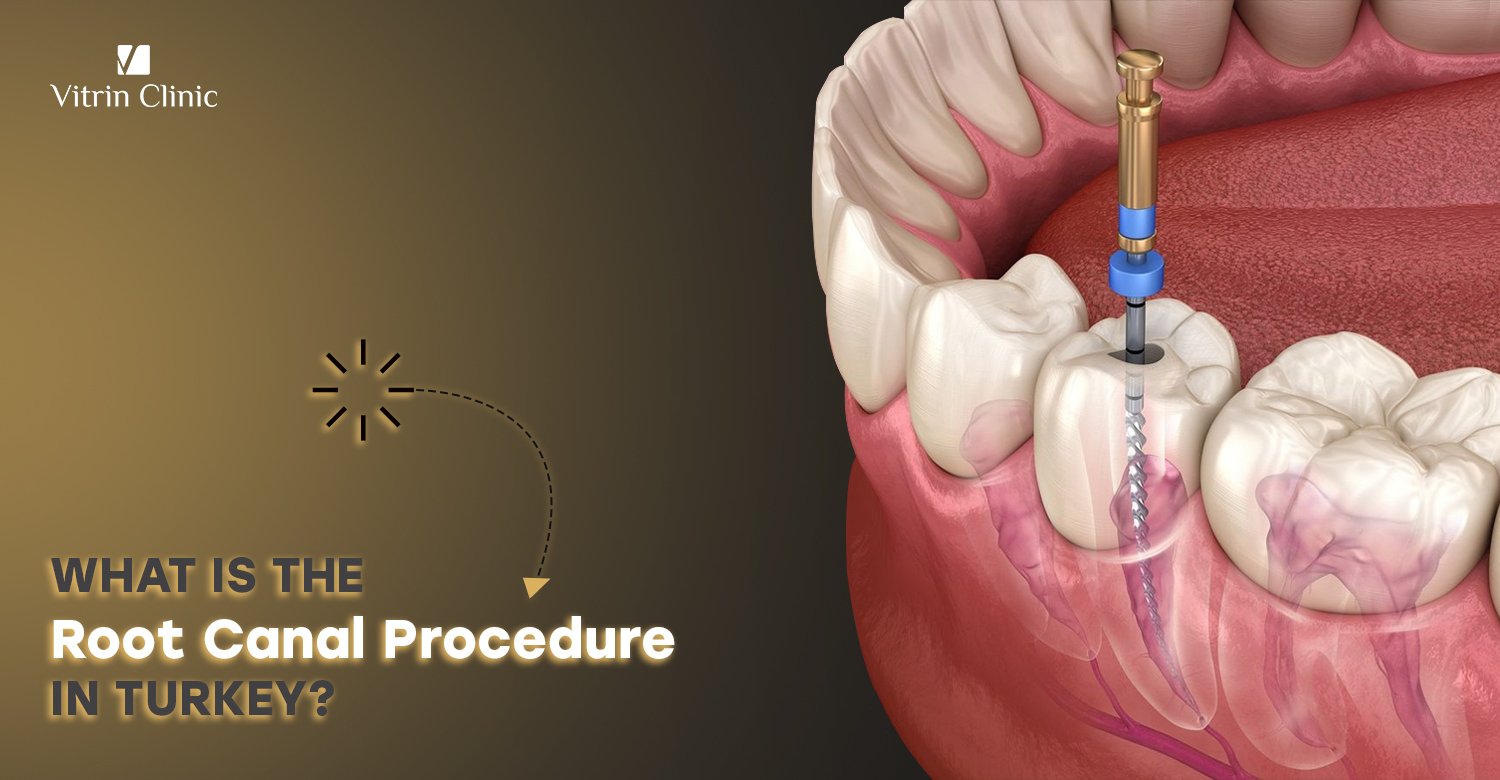 Root canal procedure