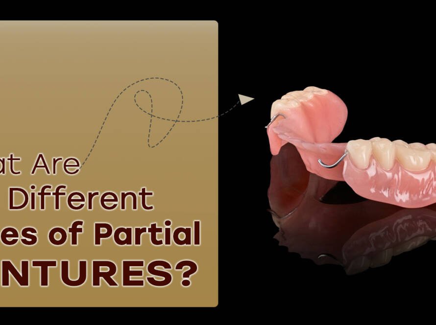 Types of partial dentures