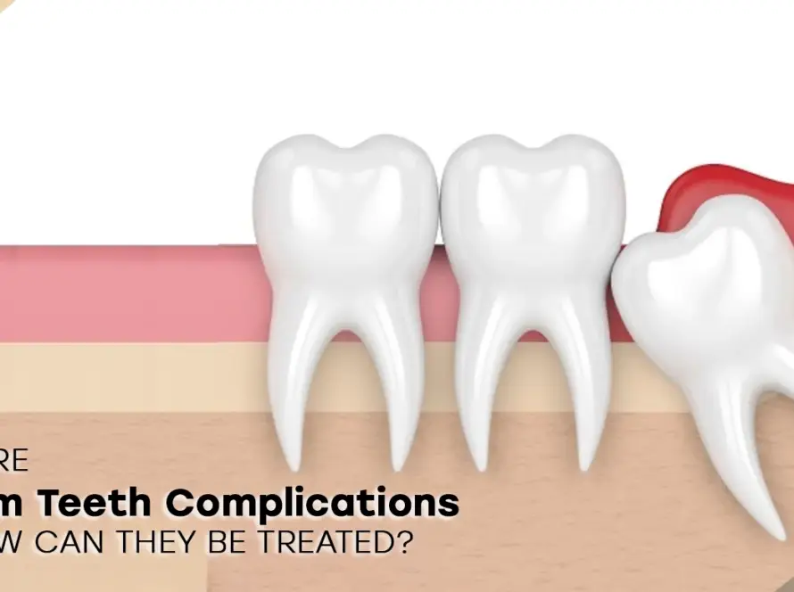 Wisdom teeth complications